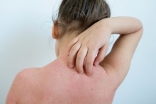 Dlaczego skóra swędzi — rodzaje świądu, dostępne leczenie i domowe metody na swędzenie