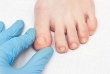 Grzybica paznokci — przyczyny, objawy, profilaktyka. Jak leczyć grzybicę paznokci?