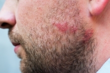 Łojotokowe zapalenie skóry – objawy, przyczyny i leczenie