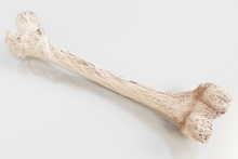 Osteoporoza - objawy, czynniki ryzyka, diagnostyka. Kto choruje na osteoporozę?